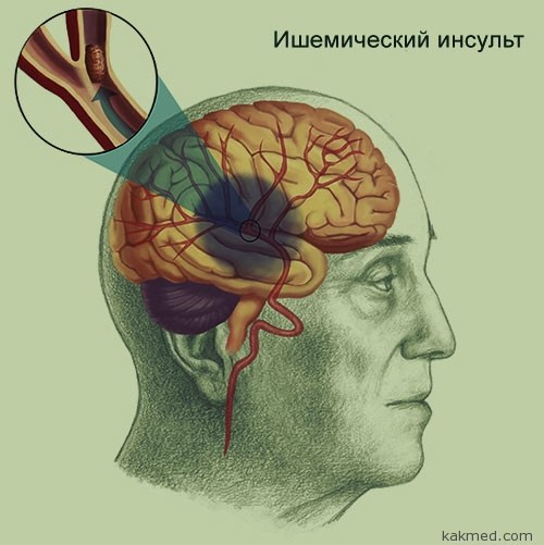 Стволовой инсульт прогноз. Ишемический инсульт ствола мозга. Стволовой инсульт мозг. Инсульт ствола головного.