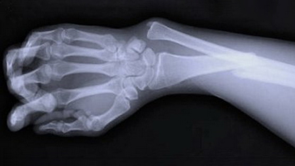 Открытый перелом кости руки. Рентген снимок трещины кости предплечья. Рентген перелома кости предплечья. Рентген переломы кисть кости. Перелом запястья рентген.