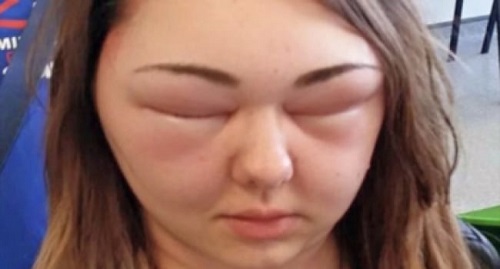 Аллергия на насекомых. Детские воспоминания